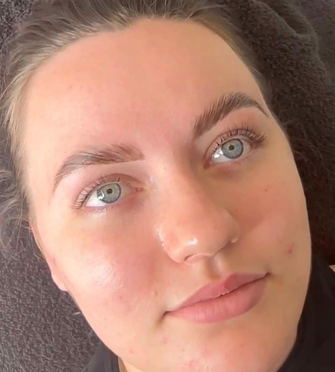 Elise Treatment photo example