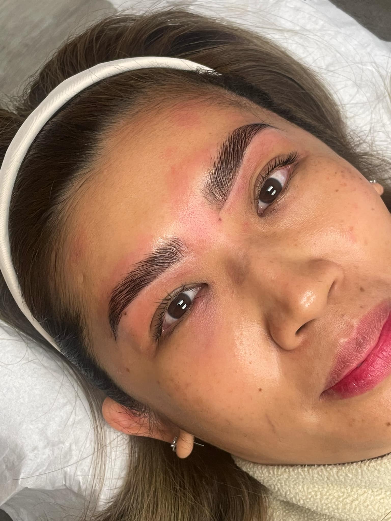 Elise Treatment photo example